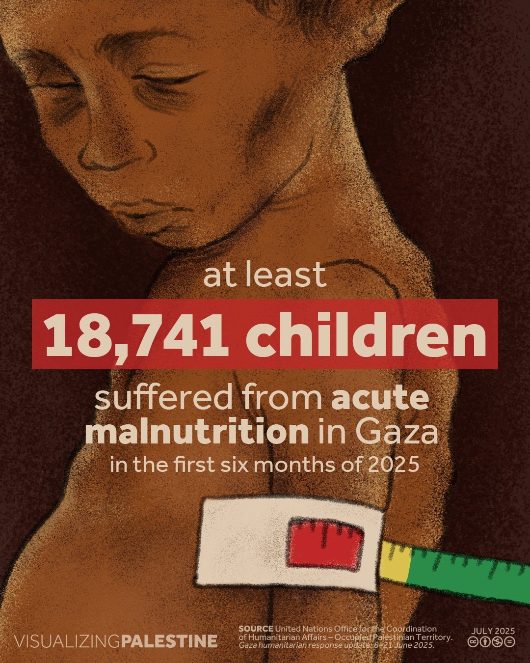 Israel’s Genocidal Violence: Starvation and Massacres in Palestine Infographic: Palestinian children suffering from malnutrition