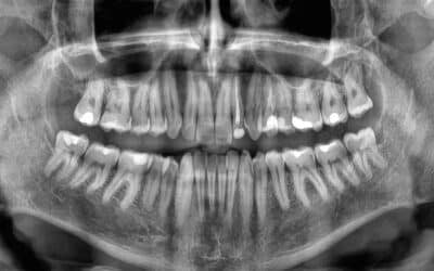 TODAYSTANCE Losing Teeth Too Fast Could Signal Higher Death Risk, Study Finds