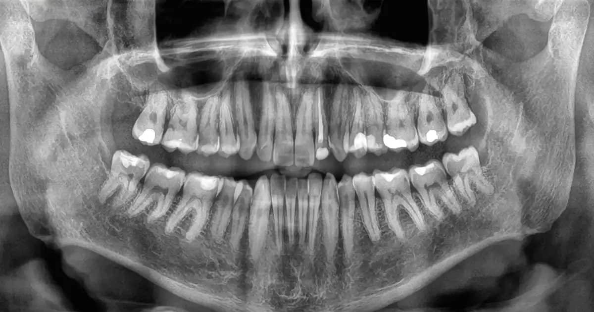 Losing Teeth Too Fast Could Signal Higher Death Risk, Study Finds Losing Teeth Too Fast Could Signal Higher Death Risk, Study Finds